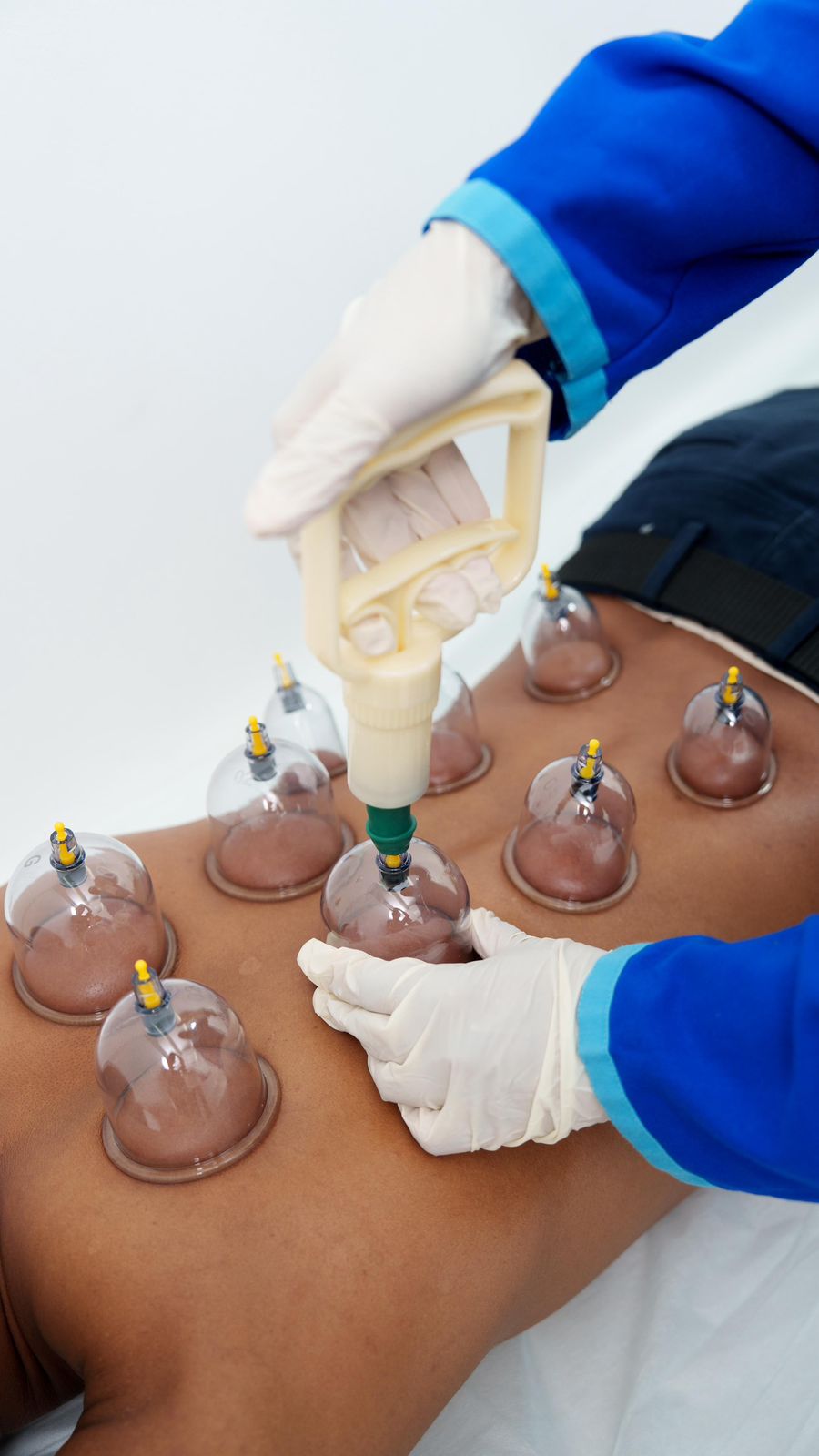 Cupping Therapy